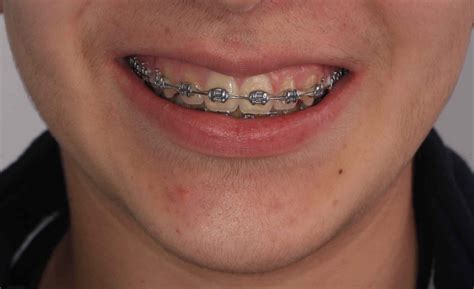 precio de brackets metalicos españa|precio de brackets en mexico.